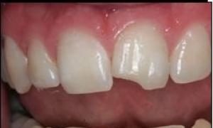 К чему снятся гнилые зубы