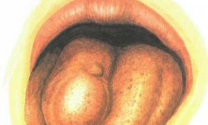 Сифилис во рту: симптомы, стадии, причины, методы диагностики и лечения